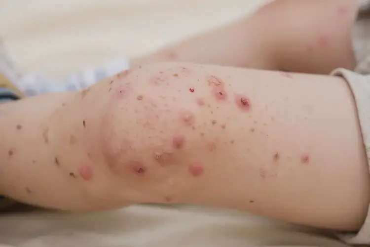 少兒小腿有濕疹不管它會自己好嗎(圖1)