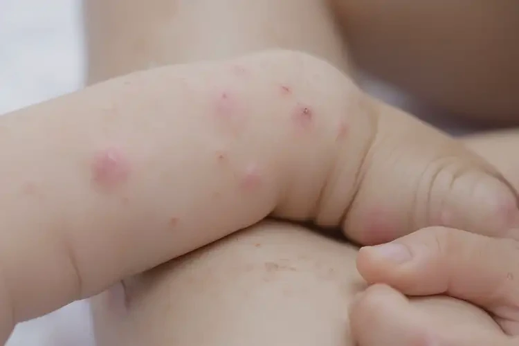 孩子四肢容易起濕疹可以徹底自愈嗎(圖4)