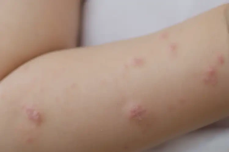 孩子手臂上有濕疹可以徹底自愈嗎(圖4)