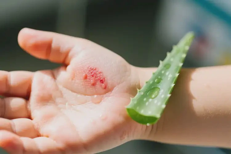 小兒手上偶爾起濕疹可以徹底自愈嗎(圖4)