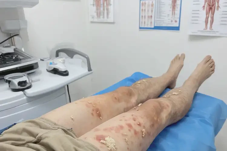 青少年大腿出湿疹不管它会自己好吗(图3)