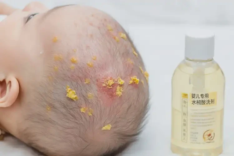 小孩屁股長(zhǎng)濕疹能夠徹底治愈嗎(圖2)