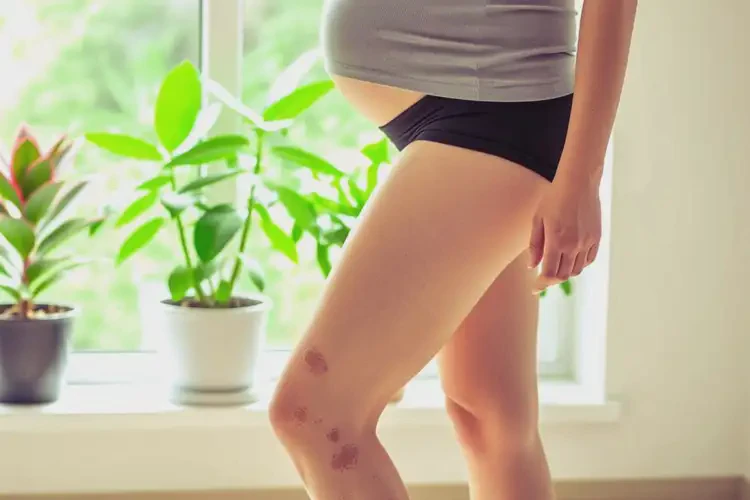 孕婦小腿上出現(xiàn)濕疹能靠自己自愈嗎(圖2)