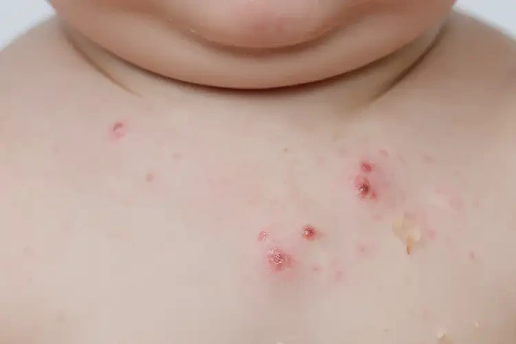 孩子脖子上容易起濕疹能靠自己自愈嗎(圖4)