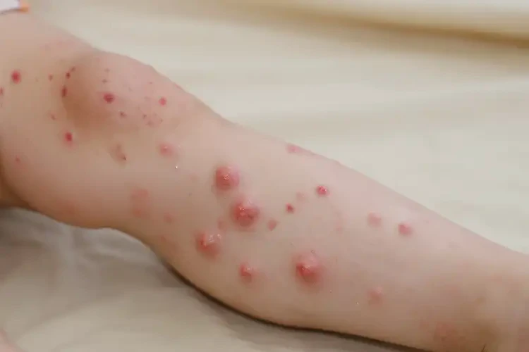 少兒小腿有濕疹不管它會自己好嗎(圖3)