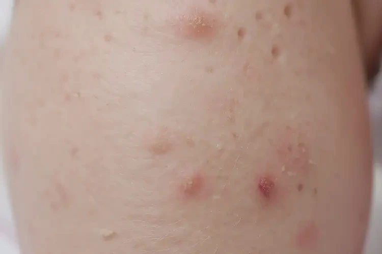 小孩大腿上出現(xiàn)濕疹不管它會自己好嗎(圖4)