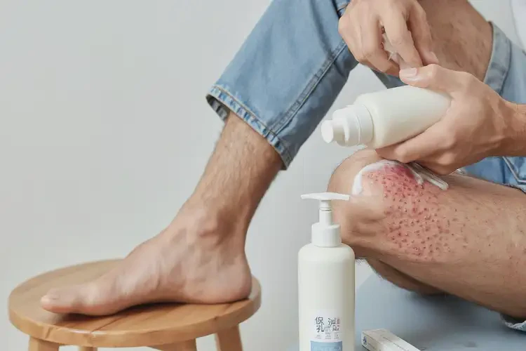 青年人大腿偶爾起濕疹能不能徹底自愈(圖3)