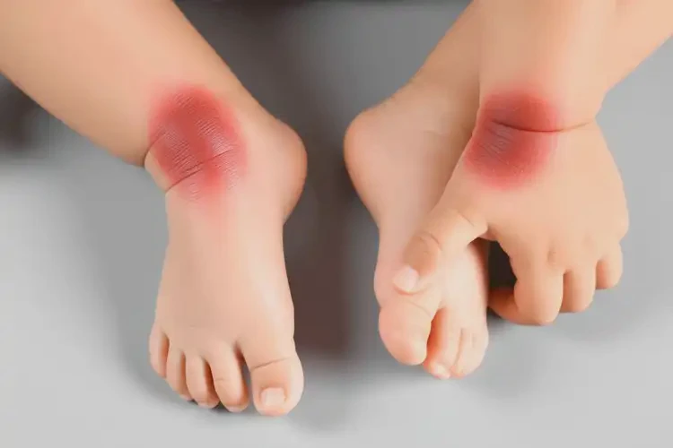 新生兒四肢長濕疹可以徹底自愈嗎(圖1)