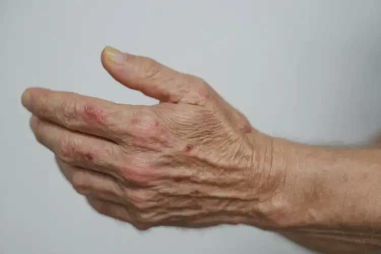 老人手上有濕疹可不可以徹底自愈(圖4)