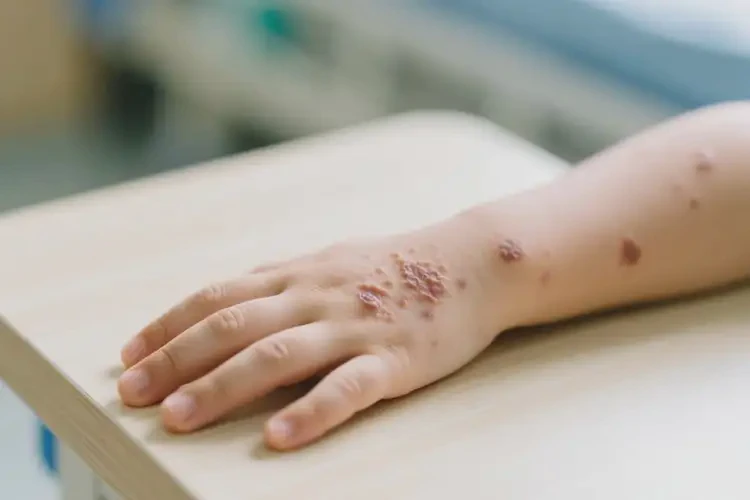 小孩手上出濕疹能徹底自愈嗎(圖4)