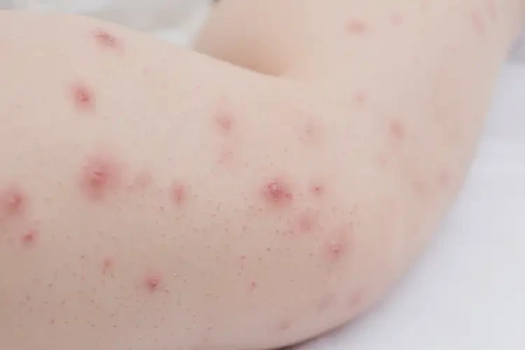 少兒小腿容易長濕疹不管它會自己痊愈嗎(圖4)