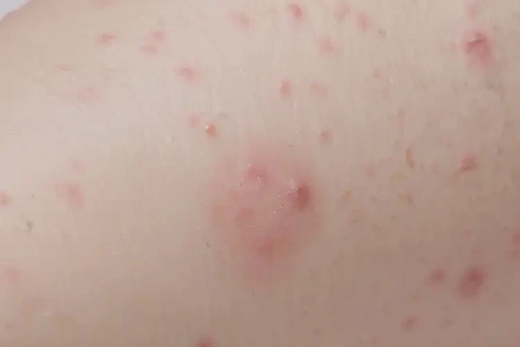 幼兒大腿上偶爾長(zhǎng)濕疹可不可以徹底自愈(圖4)