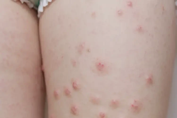 孩子大腿起湿疹能彻底自愈吗(图4)