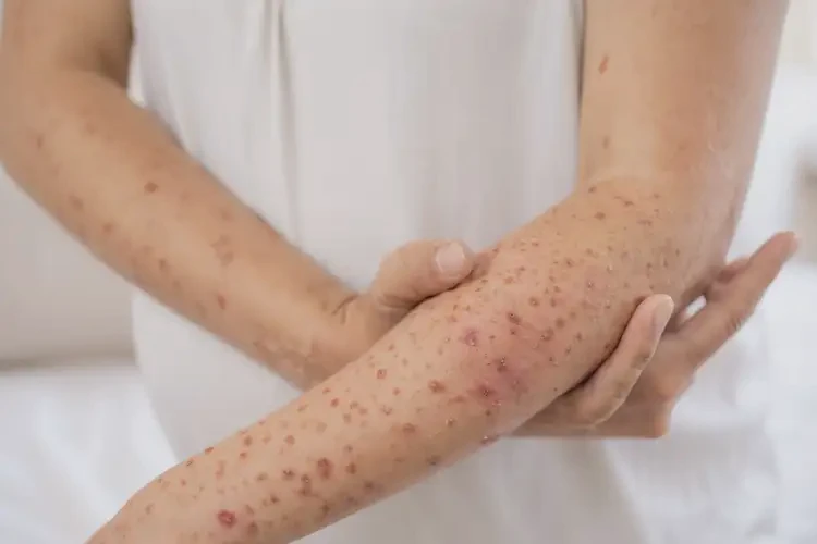 產(chǎn)婦手臂上偶爾長(zhǎng)濕疹可以徹底自愈嗎(圖4)