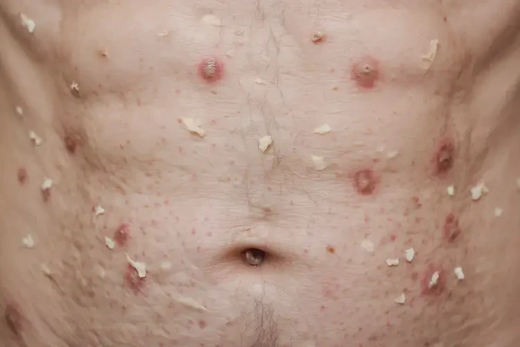 高齡老人肚子起濕疹能徹底自愈嗎(圖4)