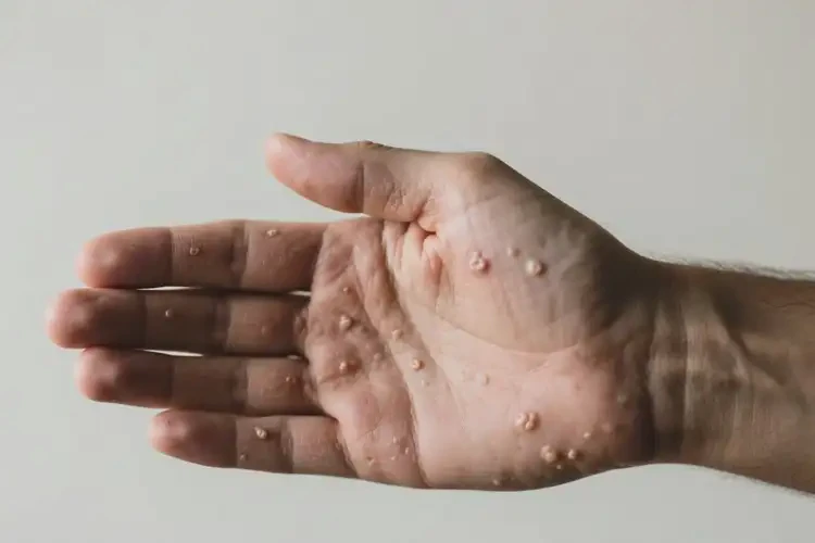 男性身上偶尔起湿疹能靠自己自愈吗(图3)