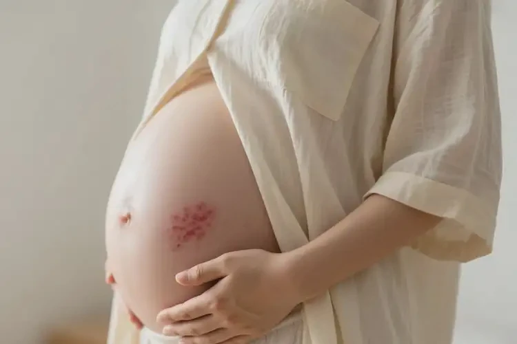 孕婦肚子上出現(xiàn)濕疹能夠徹底治愈嗎(圖4)