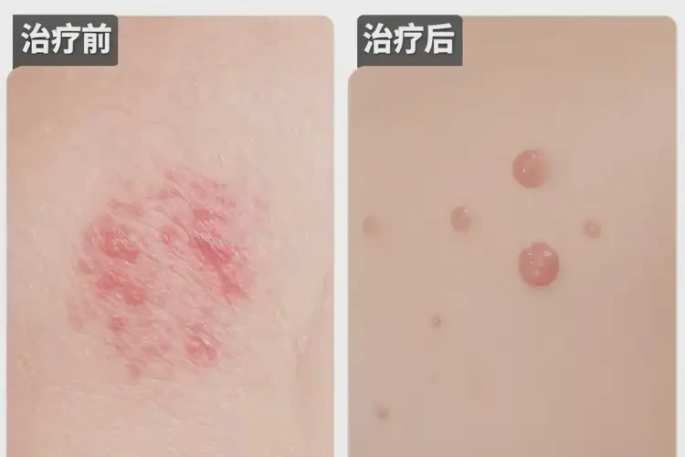 女生腳上出濕疹能徹底自愈嗎(圖1)