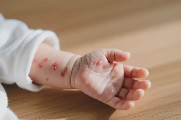 新生兒手臂容易起濕疹不管它會(huì)自己自愈嗎(圖1)