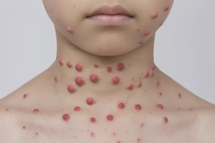 中學生脖子上偶爾起濕疹能夠徹底治愈嗎(圖3)