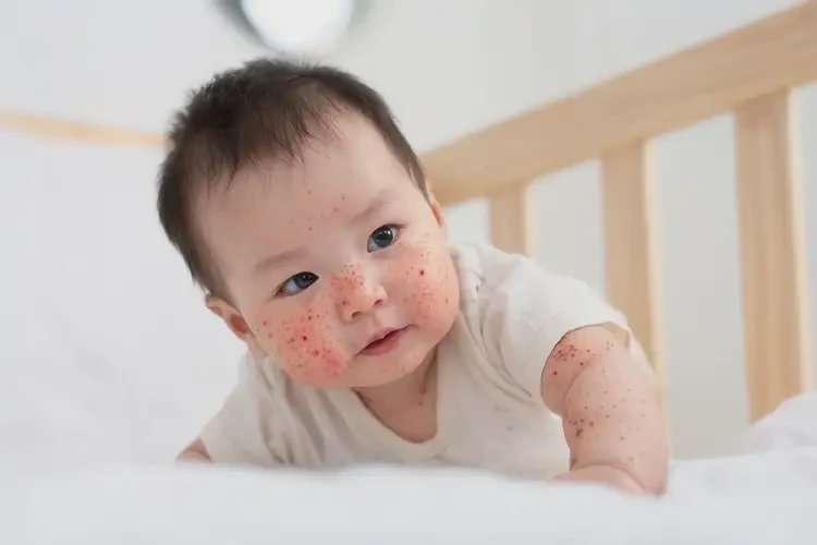 寶寶身上出現(xiàn)濕疹可以徹底自愈嗎(圖4)