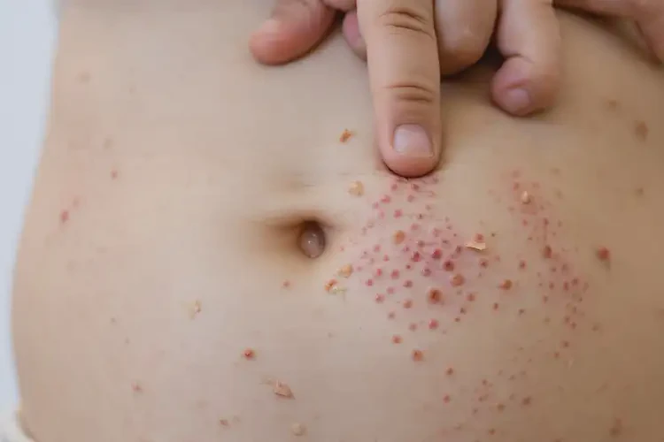 孩子肚子上經常長濕疹可以徹底自愈嗎(圖4)