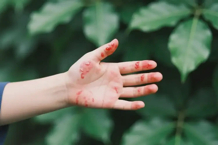 中學生四肢長濕疹能靠自己自愈嗎(圖4)