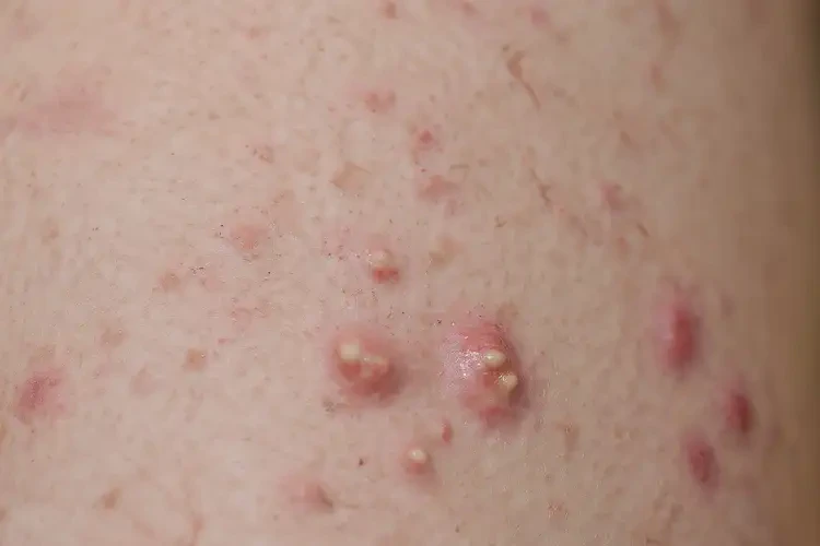 青少年大腿上容易起濕疹不管它會(huì)自己痊愈嗎(圖4)