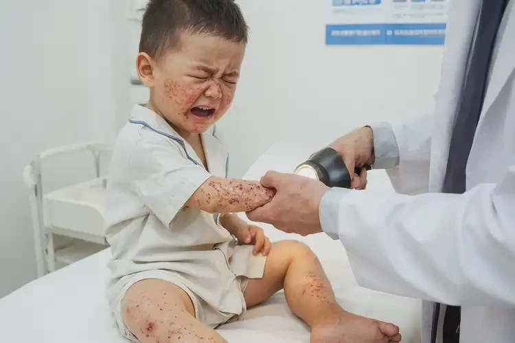 小孩全身長濕疹可以徹底自愈嗎(圖4)
