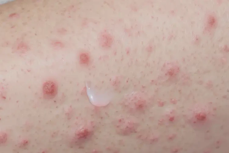 女性手臂上偶爾長濕疹可不可以徹底自愈(圖3)