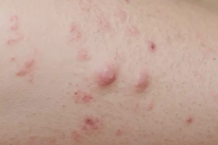 青少年大腿上起濕疹能不能徹底自愈(圖4)