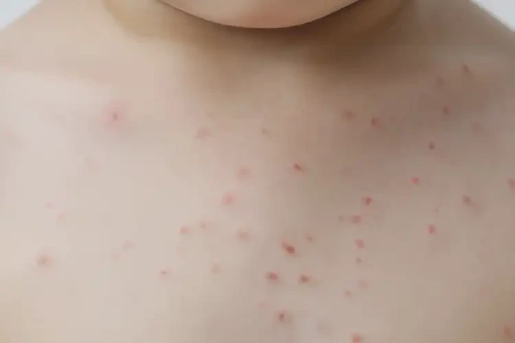 少儿脖子长湿疹能够彻底治愈吗(图3)