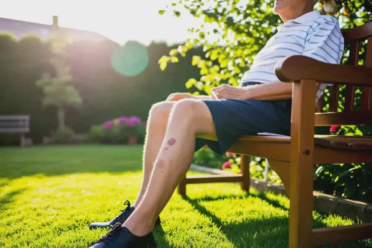 老年人小腿長濕疹能徹底自愈嗎(圖4)