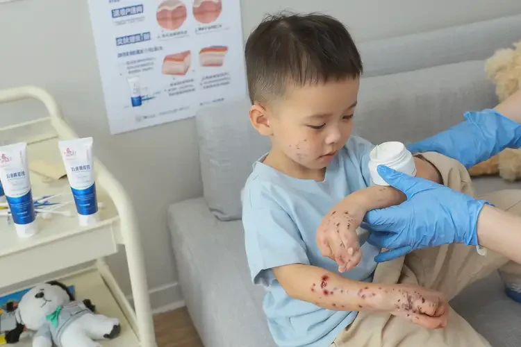 幼兒四肢容易起濕疹不管它會自己自愈嗎(圖3)