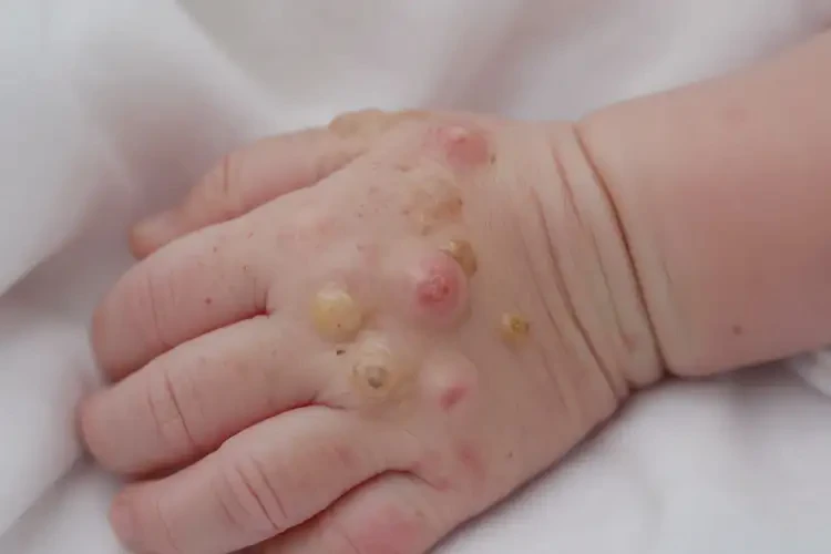 新生兒手上長濕疹不管它會自己好嗎(圖3)