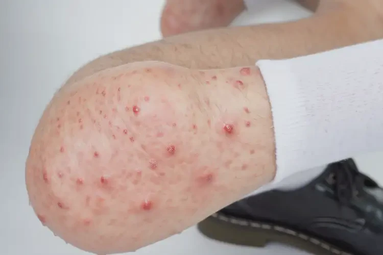 中學(xué)生腳上有濕疹不管它會(huì)自己痊愈嗎(圖4)