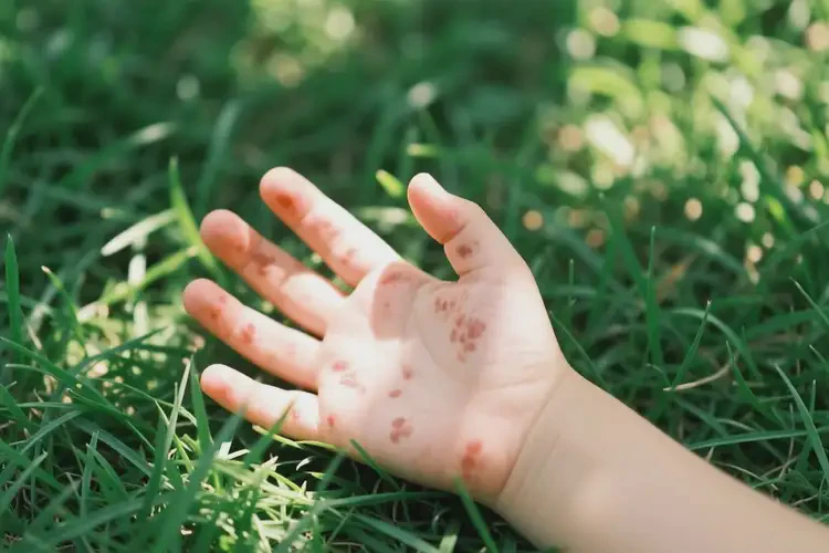 小孩手上出濕疹能徹底自愈嗎(圖3)