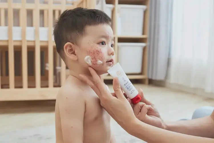幼兒面部長(zhǎng)濕疹不管它會(huì)自己好嗎(圖3)