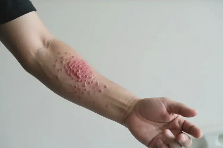 男人手臂上經(jīng)常起濕疹不管它會(huì)自己好嗎(圖4)