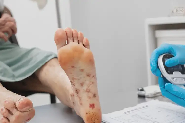 女性腳上長濕疹能靠自己自愈嗎(圖4)