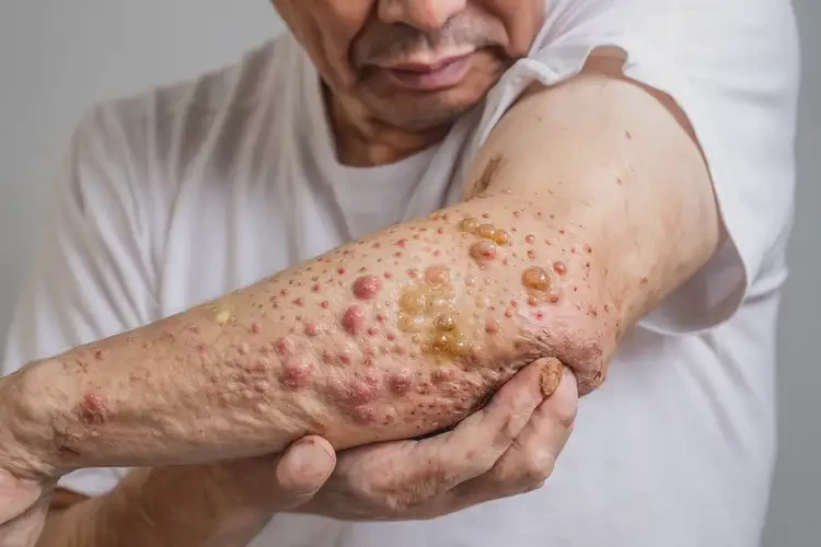 小學生大腿上偶爾起濕疹不管它會自己自愈嗎(圖2)