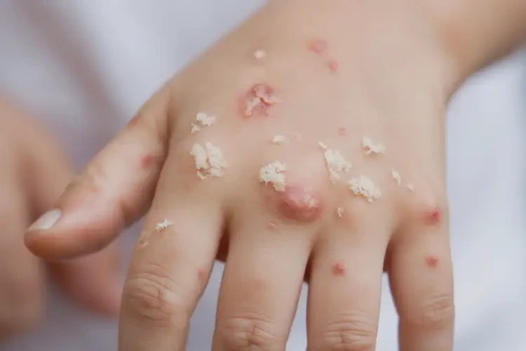小學(xué)生手上長濕疹能徹底自愈嗎(圖4)