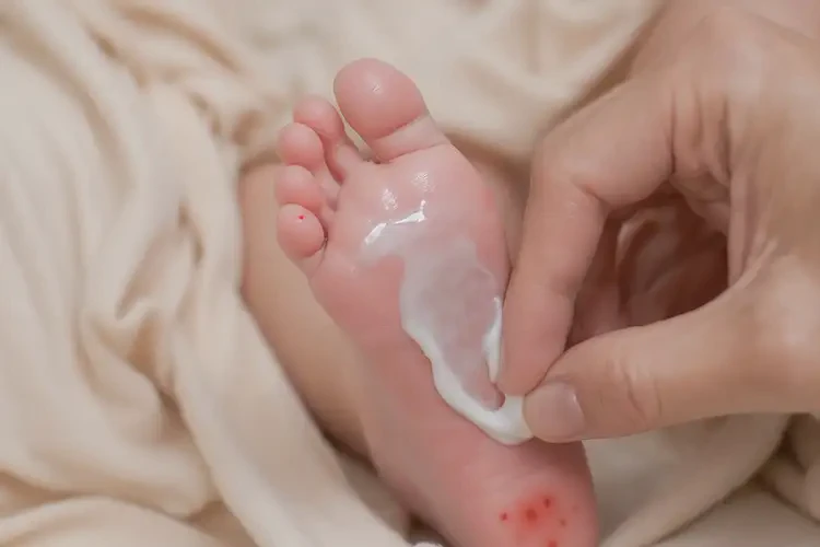 新生兒腳上起濕疹不管它會自己好嗎(圖2)