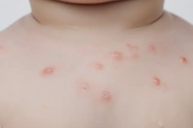 嬰兒脖子經(jīng)常長(zhǎng)濕疹不管它會(huì)自己痊愈嗎(圖4)