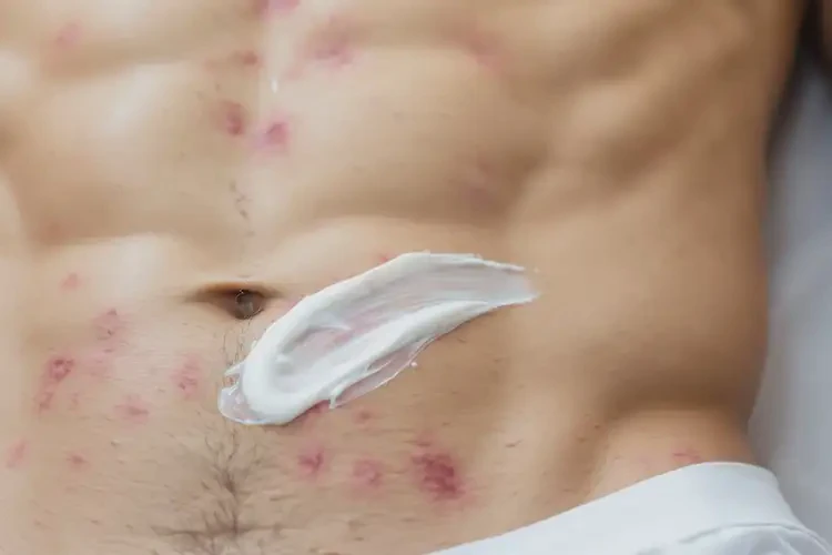 男性肚子長(zhǎng)濕疹不管它會(huì)自己痊愈嗎(圖3)