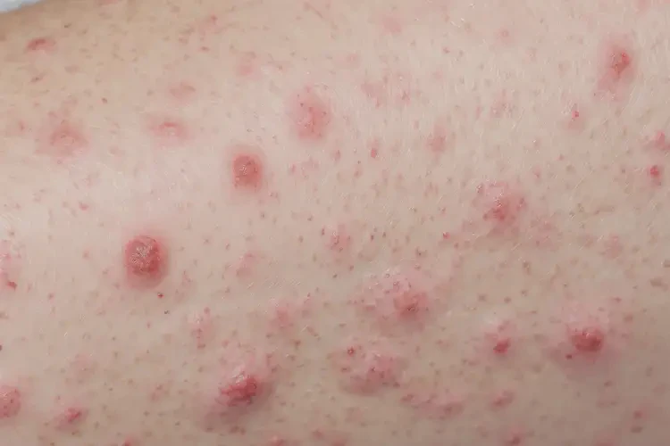 女性手臂上偶爾長濕疹可不可以徹底自愈(圖4)