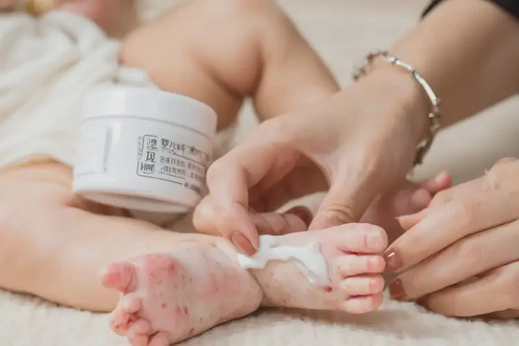 新生兒腳上經(jīng)常長濕疹不管它會(huì)自己好嗎(圖3)