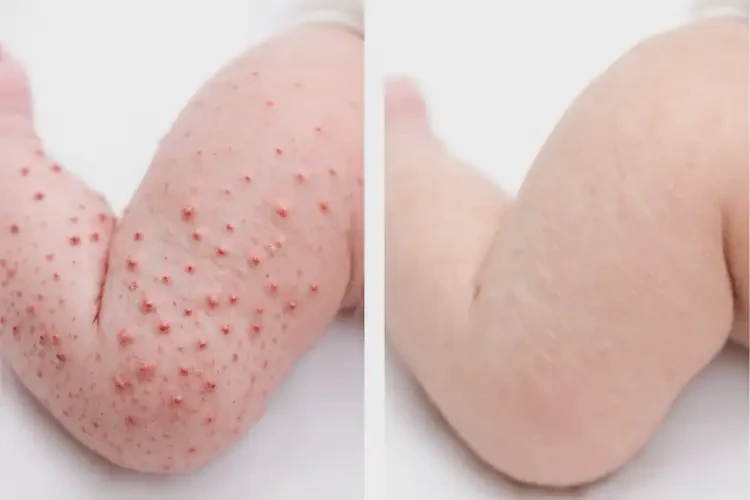 新生儿小腿上出湿疹可不可以彻底自愈(图2)