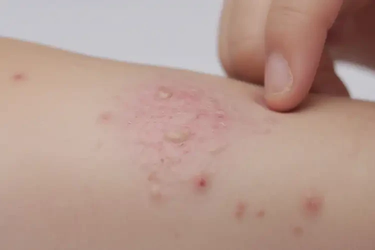 孩子肛周偶爾起濕疹不管它會自己好嗎(圖4)