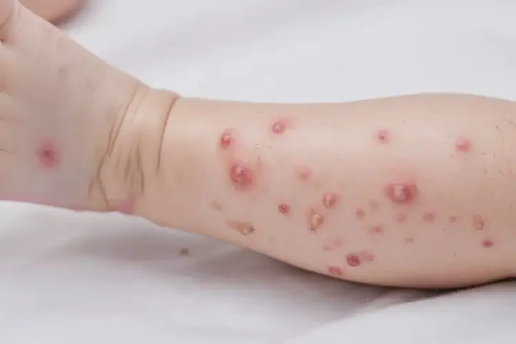 嬰兒小腿上長(zhǎng)濕疹能靠自己自愈嗎(圖3)